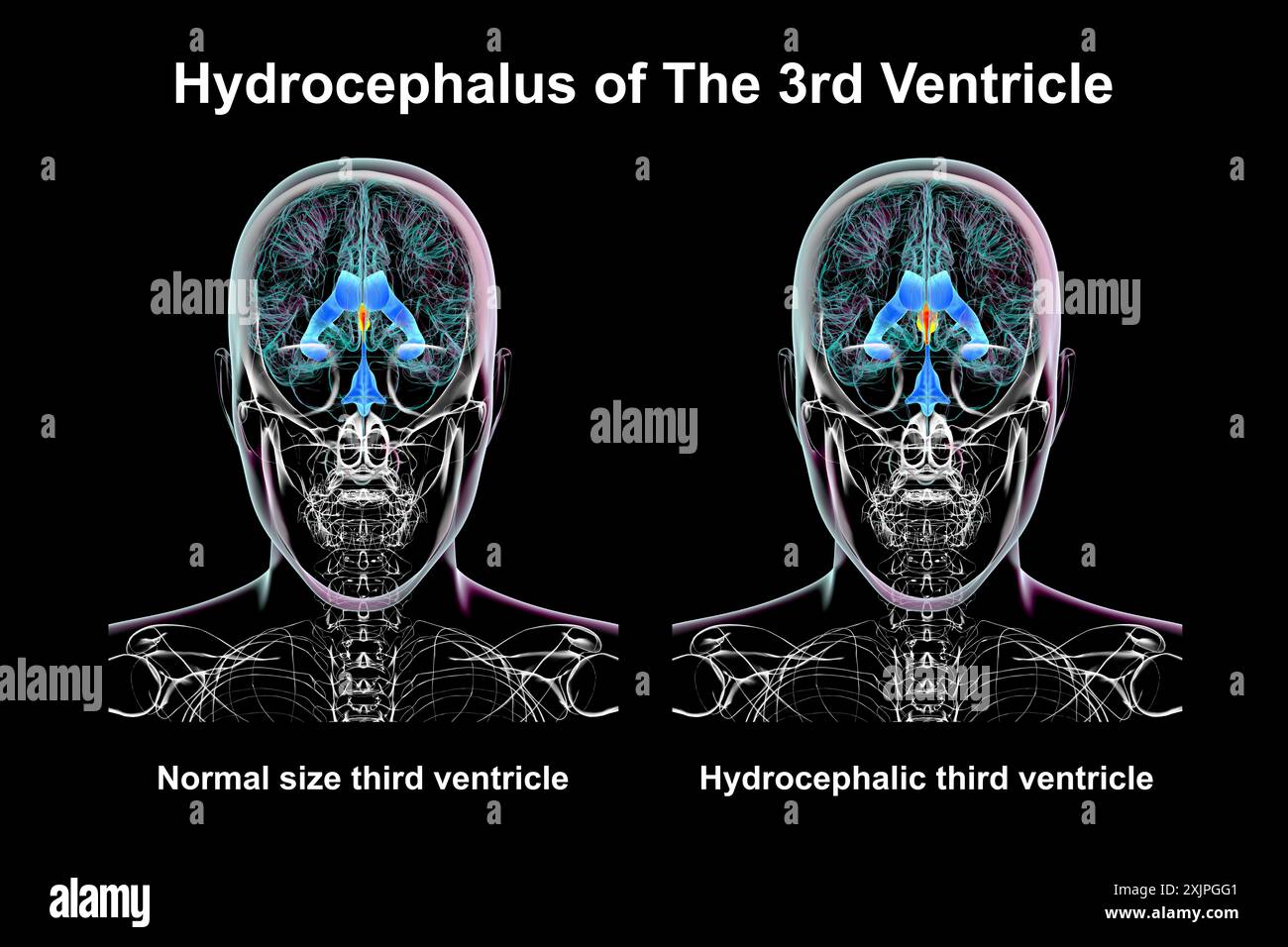 Illustration représentant un agrandissement isolé du troisième ventricule cérébral (droit) par rapport au troisième ventricule de taille normale (gauche), vue de face. Banque D'Images