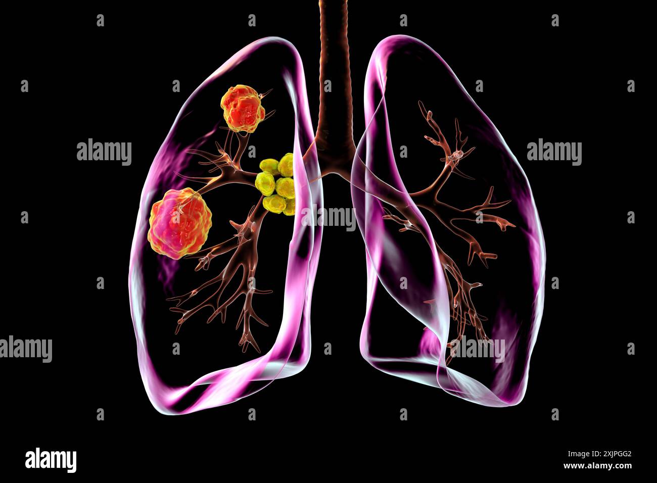 Illustration d'une blastomycose pulmonaire avec lésions pulmonaires et hypertrophie ganglionnaire bronchique. Banque D'Images