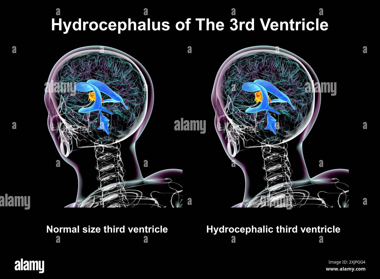 Illustration représentant un agrandissement isolé du troisième ventricule cérébral (droit) par rapport au troisième ventricule de taille normale (gauche). Banque D'Images