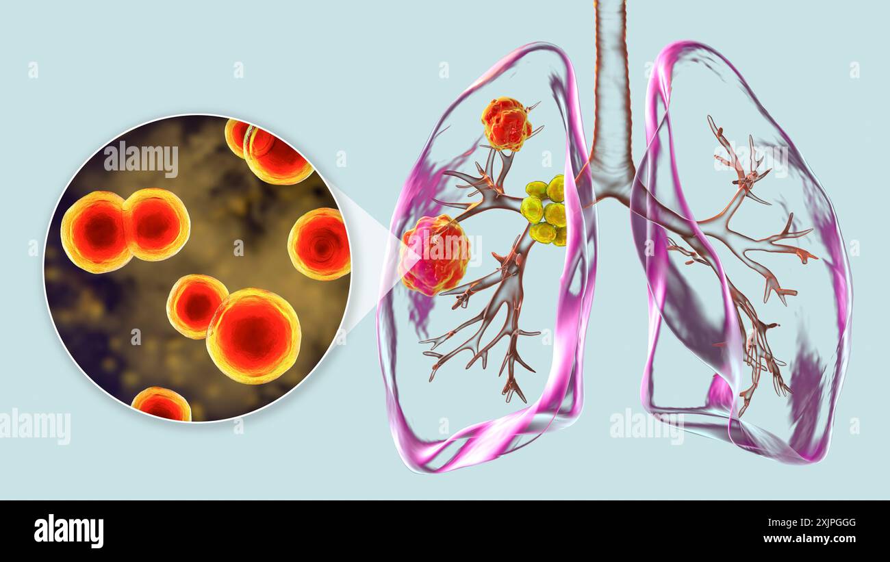 Illustration d'une blastomycose pulmonaire avec lésions pulmonaires et hypertrophie ganglionnaire bronchique et vue rapprochée du champignon Blastomyces dermatitidis. Banque D'Images