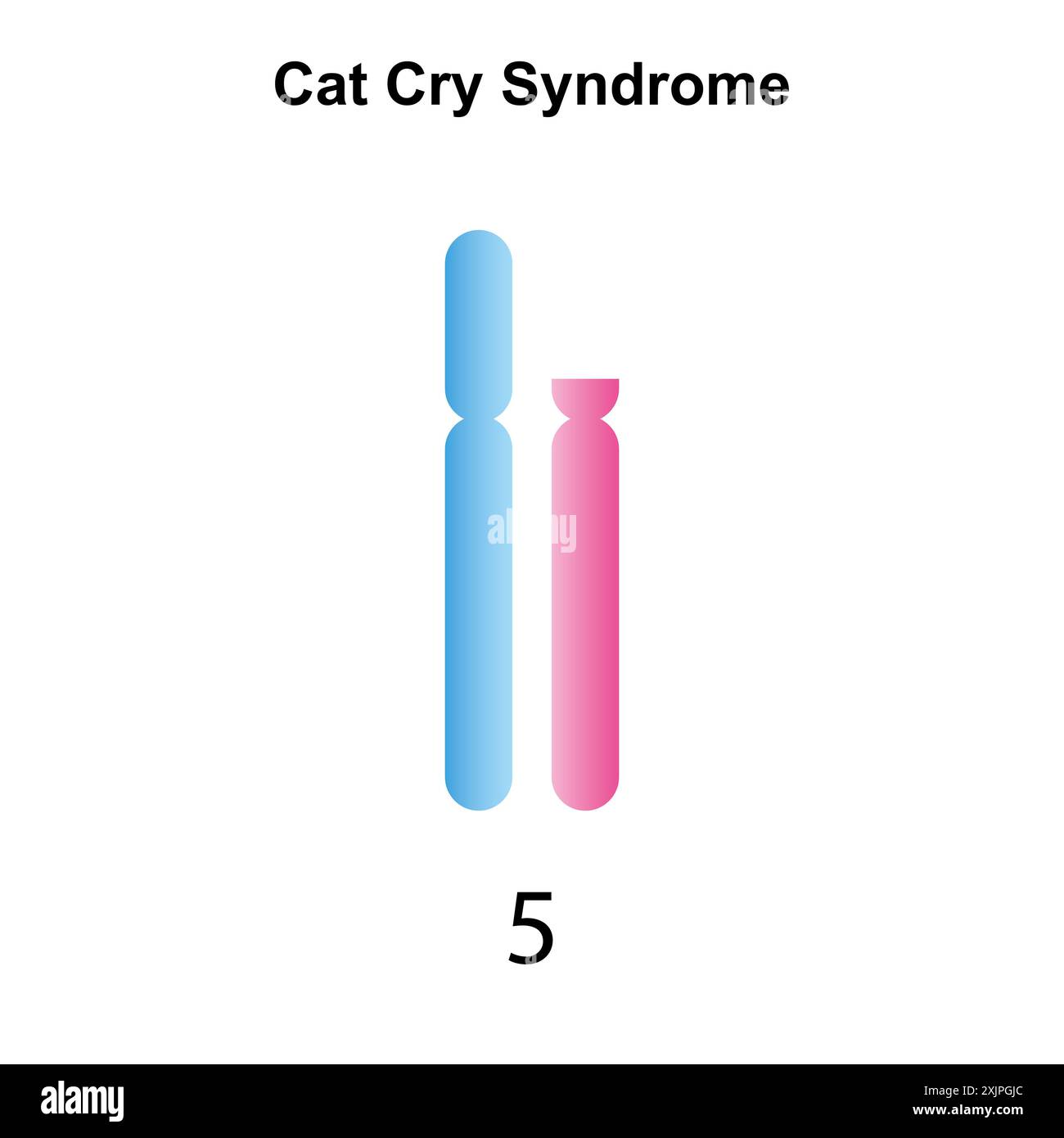 Syndrome de cri de chat, illustration. Banque D'Images