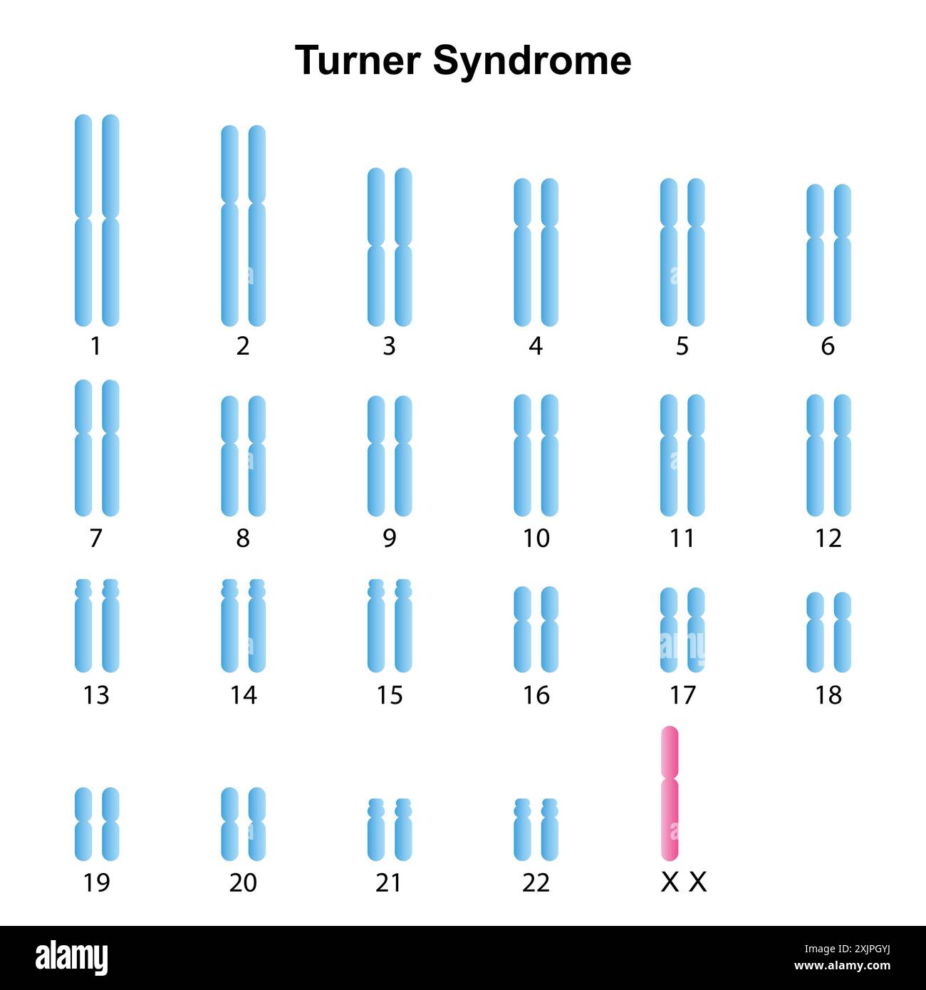 Syndrome de Turner, illustration. Banque D'Images