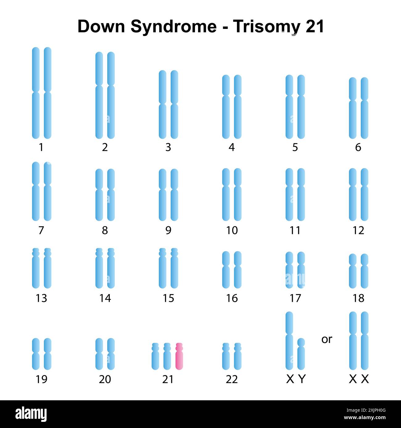 Syndrome de trisomie 21, illustration. Banque D'Images