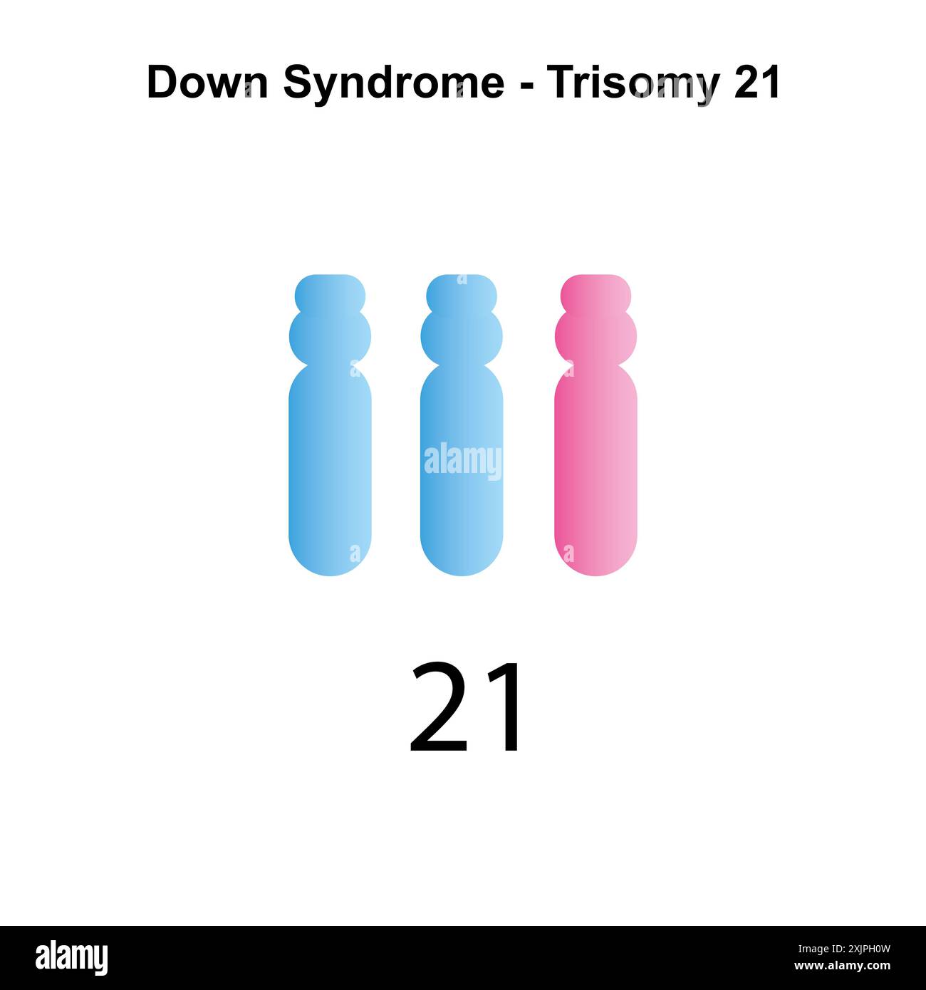 syndrome-de-down-caryotype-banque-de-photographies-et-d-images-haute