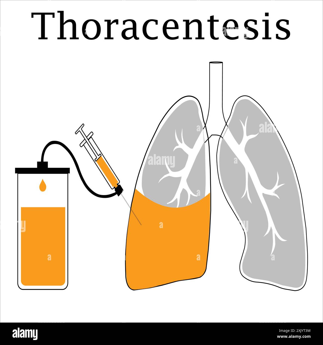 Poster médical sur la procédure de thoracentèse - incision de la paroi thoracique, retrait de liquide du poumon comprimé Illustration de Vecteur