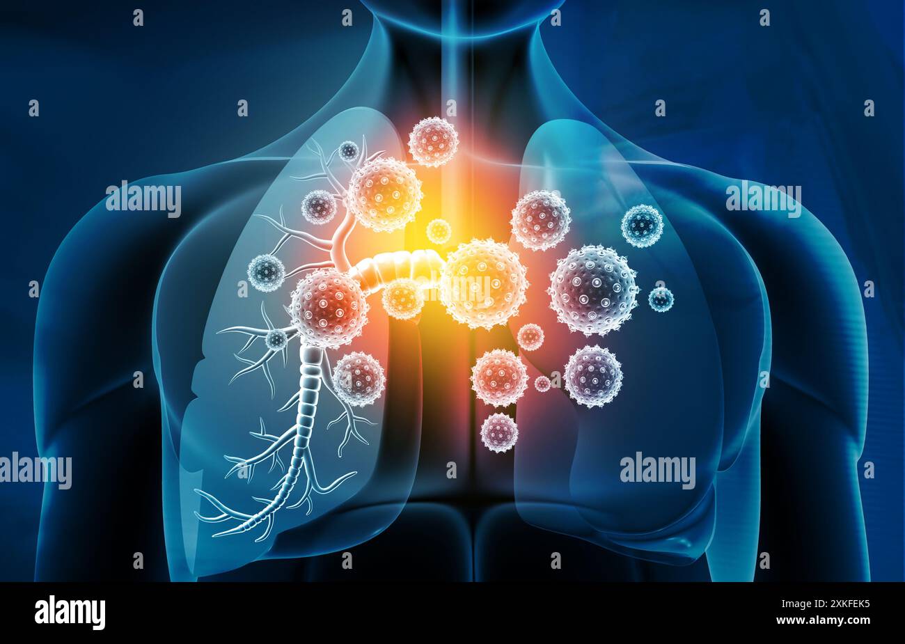 Infections pulmonaires virales, infection pulmonaire conepte. illustration 3d. Banque D'Images