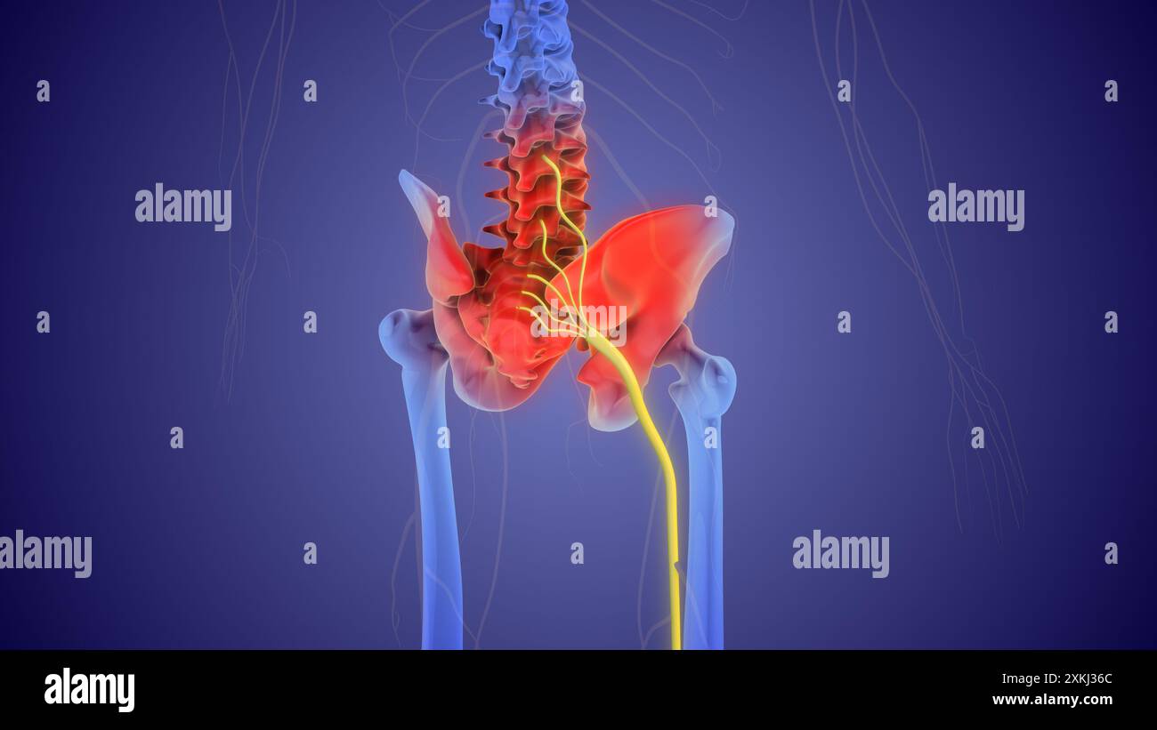 Le concept médical de la douleur du nerf sciatique Banque D'Images