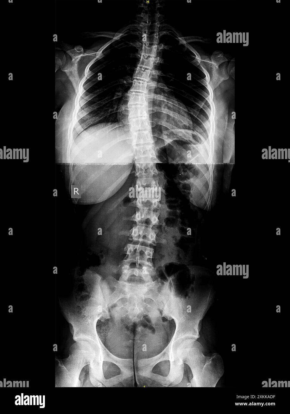 La radiographie des scolioses idiopathiques en S du rachis thoracique et lombaire. Partie du squelette avec courbure spinale sur fond noir. Déformation latérale du rachis. Image radiologique du dos et du bassin. Banque D'Images