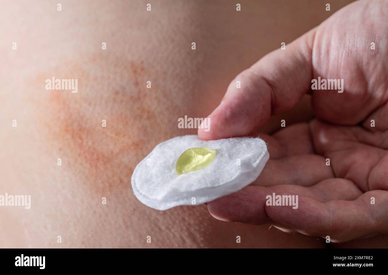 La main d un homme tient un coton avec un gel médical médicinal sur le fond d une bosse et d ecchymose après une injection. Traitement de la post-injection Banque D'Images