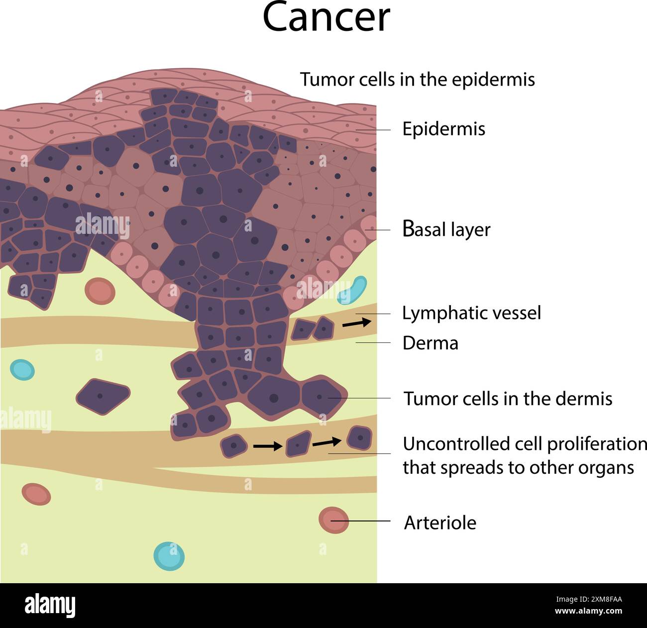 Cancer et métastases. Illustration de Vecteur