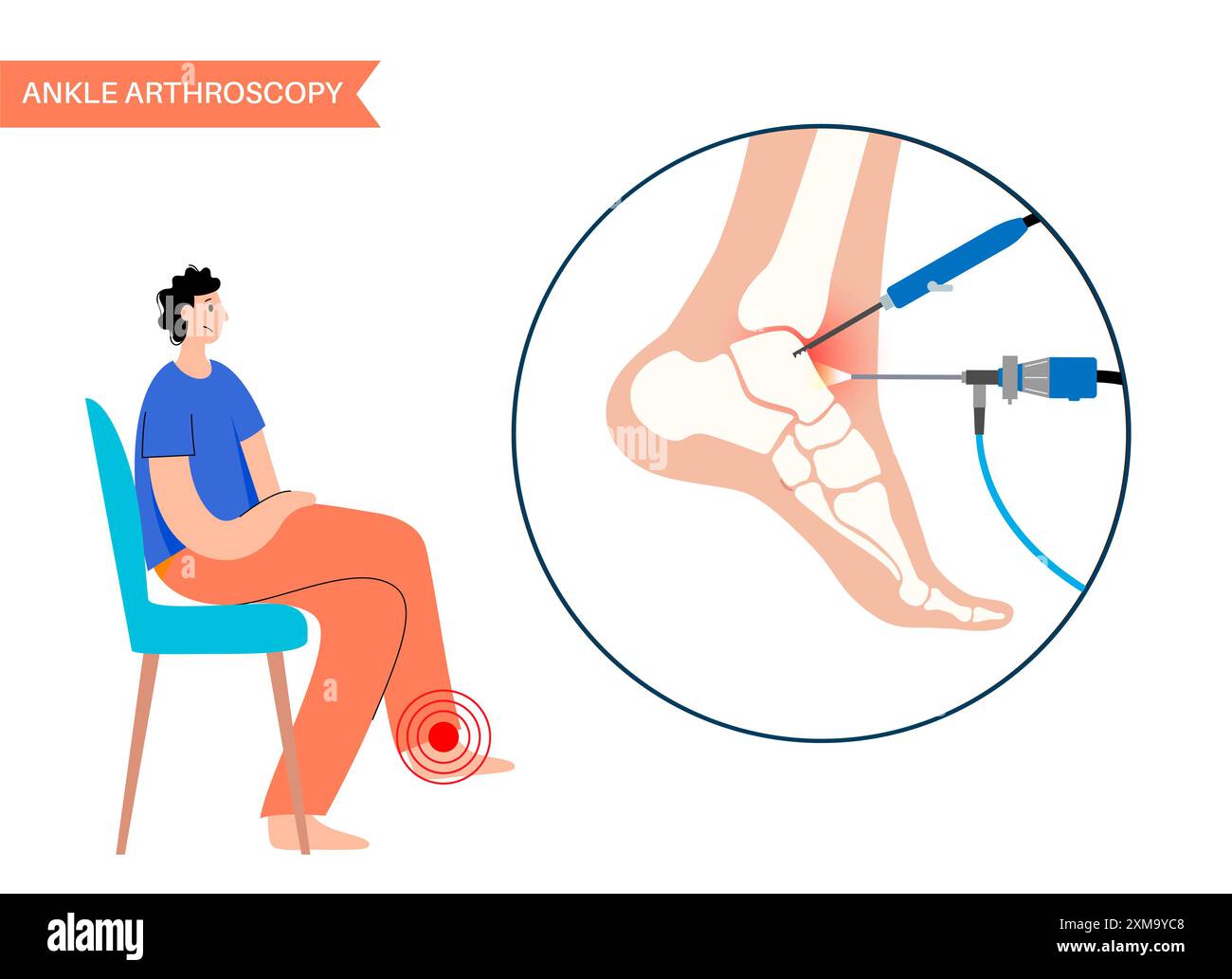 Illustration d'un procédé d'arthroscopie de cheville. Il s'agit d'une procédure de diagnostic et de traitement des problèmes articulaires. Un chirurgien insère un tube étroit attaché à une caméra vidéo à fibre optique à travers une petite incision. Banque D'Images