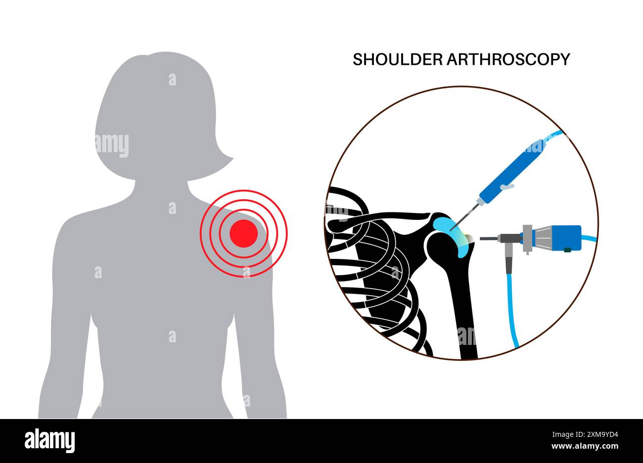 Illustration d'un procédé d'arthroscopie de l'épaule. Il s'agit d'une procédure de diagnostic et de traitement des problèmes articulaires. Un chirurgien insère un tube étroit attaché à une caméra vidéo à fibre optique à travers une petite incision. Banque D'Images