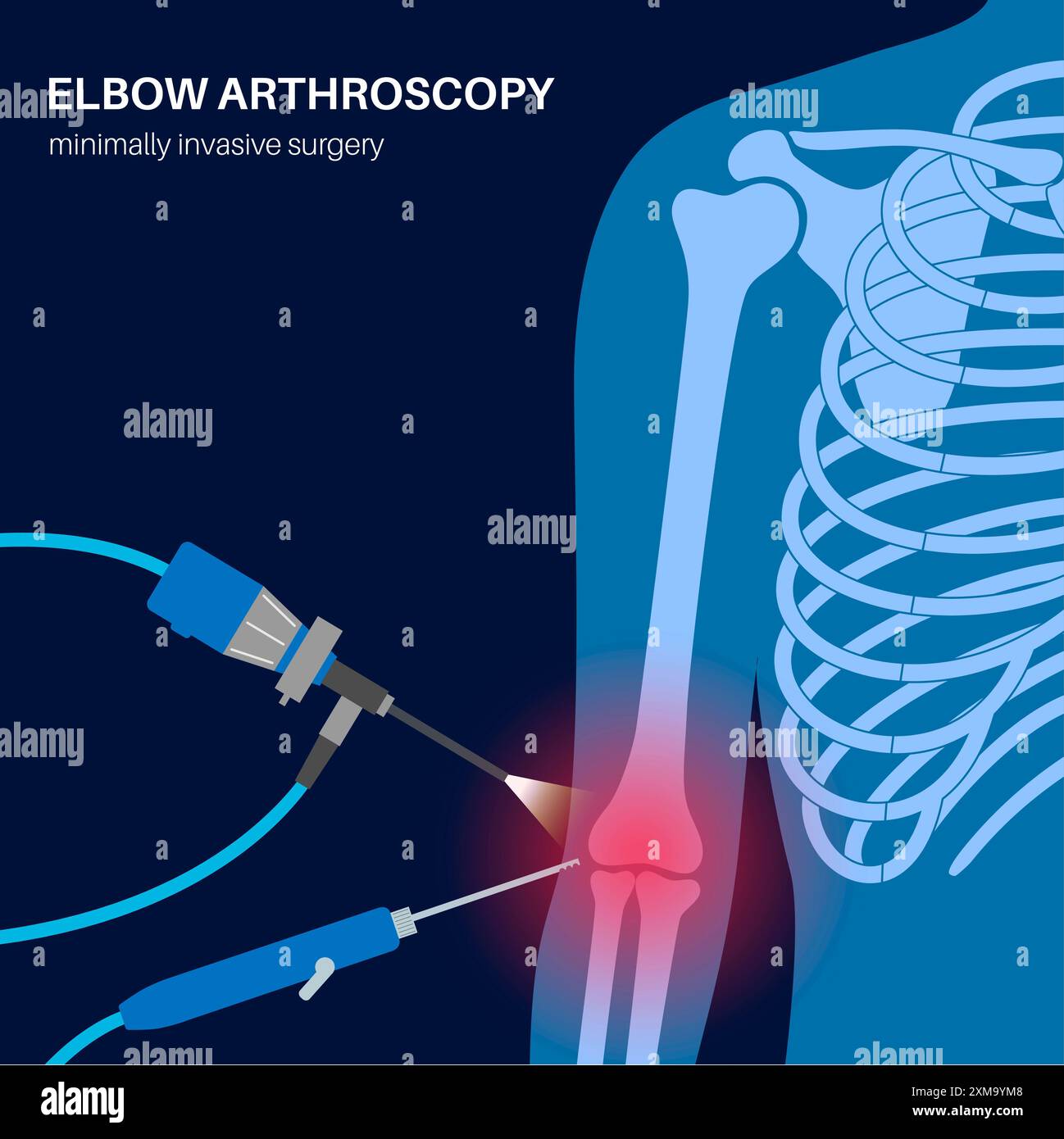 Illustration de la chirurgie arthroscopique du coude. Il s'agit d'une procédure de diagnostic et de traitement des problèmes articulaires. Un chirurgien insère un tube étroit attaché à une caméra vidéo à fibre optique à travers une petite incision. Banque D'Images