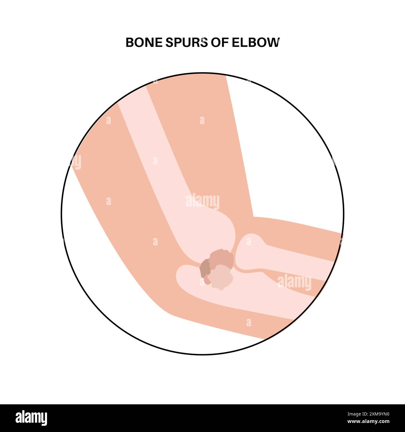 Illustration de la chirurgie arthroscopique du coude. Il s'agit d'une procédure de diagnostic et de traitement des problèmes articulaires. Un chirurgien insère un tube étroit attaché à une caméra vidéo à fibre optique à travers une petite incision. Banque D'Images