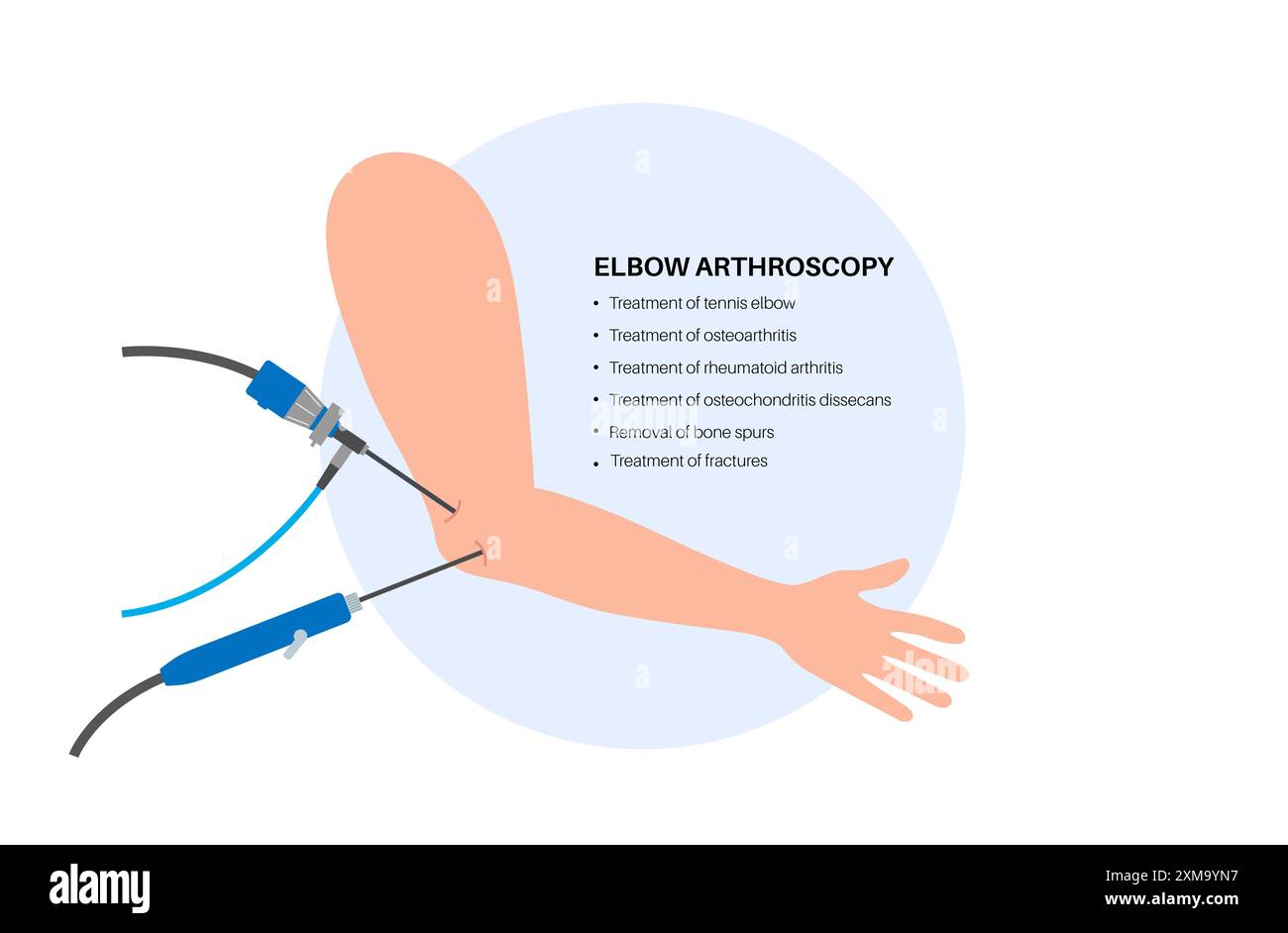 Illustration de la chirurgie arthroscopique du coude. Il s'agit d'une procédure de diagnostic et de traitement des problèmes articulaires. Un chirurgien insère un tube étroit attaché à une caméra vidéo à fibre optique à travers une petite incision. Banque D'Images