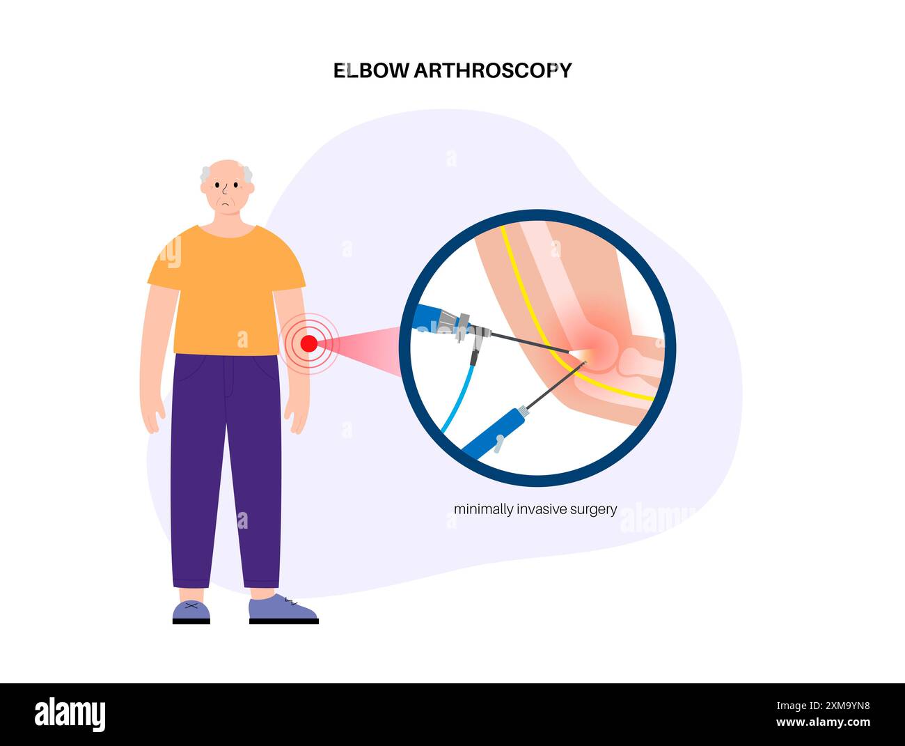 Illustration de la chirurgie arthroscopique du coude. Il s'agit d'une procédure de diagnostic et de traitement des problèmes articulaires. Un chirurgien insère un tube étroit attaché à une caméra vidéo à fibre optique à travers une petite incision. Banque D'Images