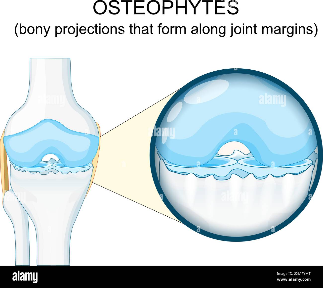 Ostéophyte. Anatomie de l'arthrose du genou humain. Éperons osseux. Gros plan d'une articulation synoviale avec dégénérescence du cartilage. Formation d'ostéophytes. V Illustration de Vecteur