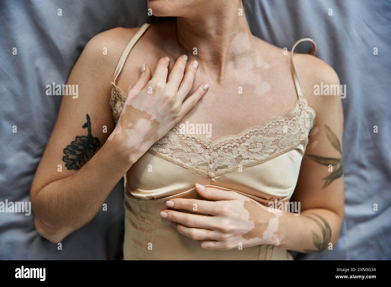 Une jeune femme avec du vitiligo et un tatouage se trouve sur son lit, portant un caraco soyeux. Banque D'Images