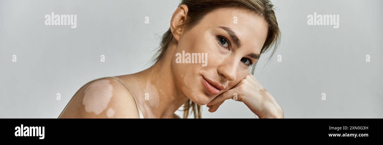 Une jeune femme atteinte de vitiligo repose la tête sur sa main, regardant soigneusement la caméra. Banque D'Images