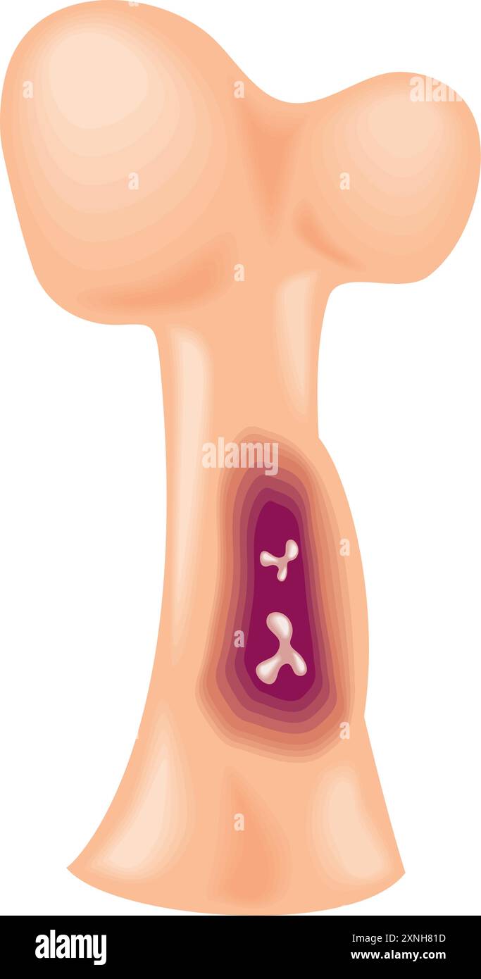 myélome multiple section transversale des os Illustration de Vecteur