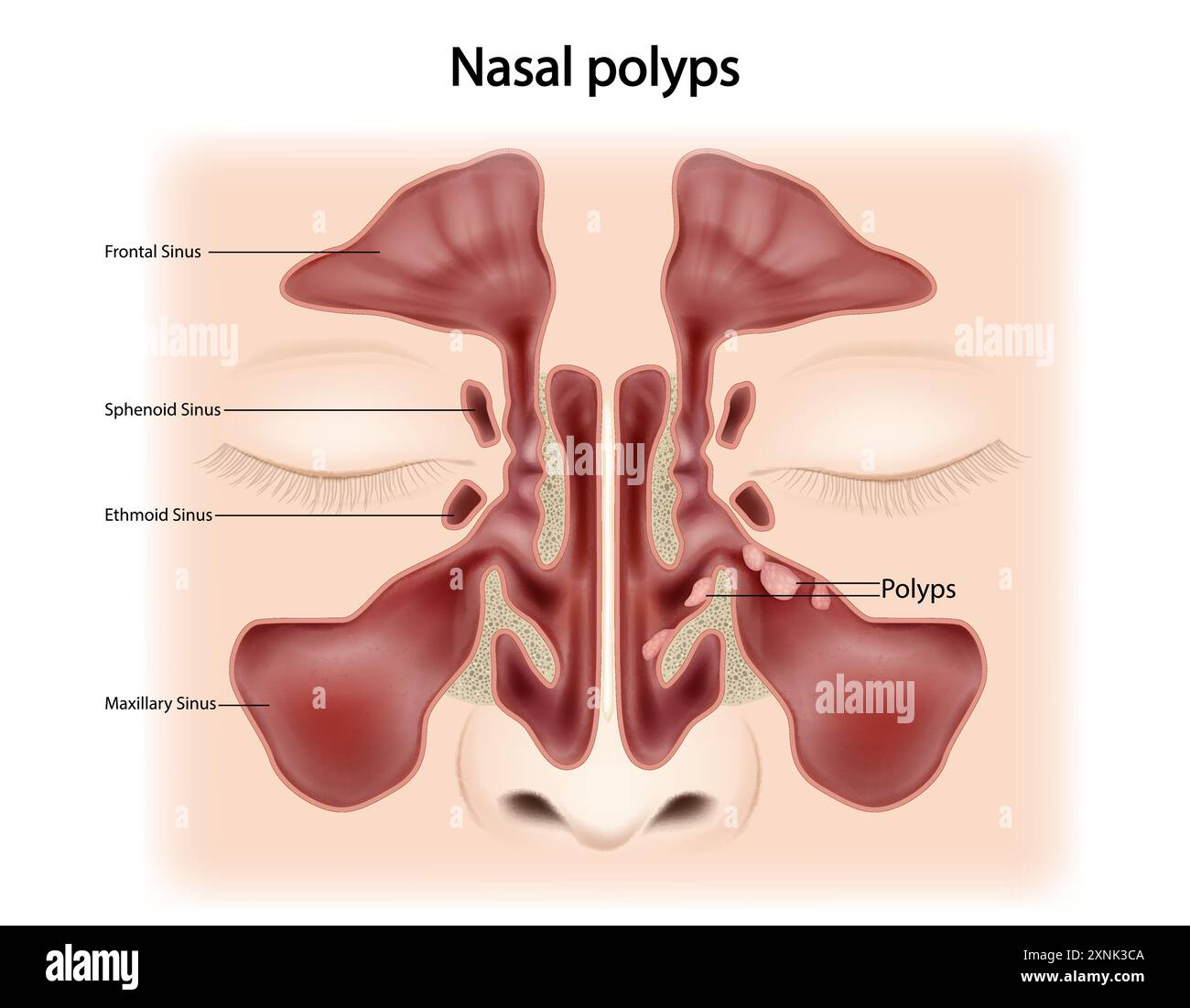 Polypes nasaux excroissances non cancéreuses sur la muqueuse du nez ou des sinus. Oto-rhino-laryngologie Illustration de Vecteur