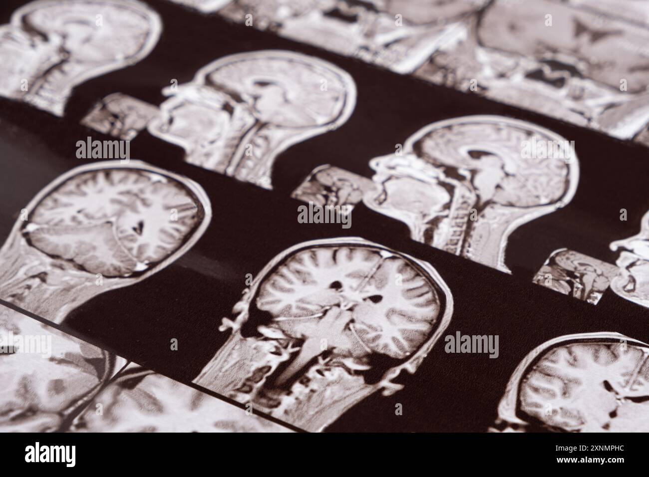 Imagerie par résonance magnétique de la tête d'une personne saine, image de l'hypophyse. Banque D'Images