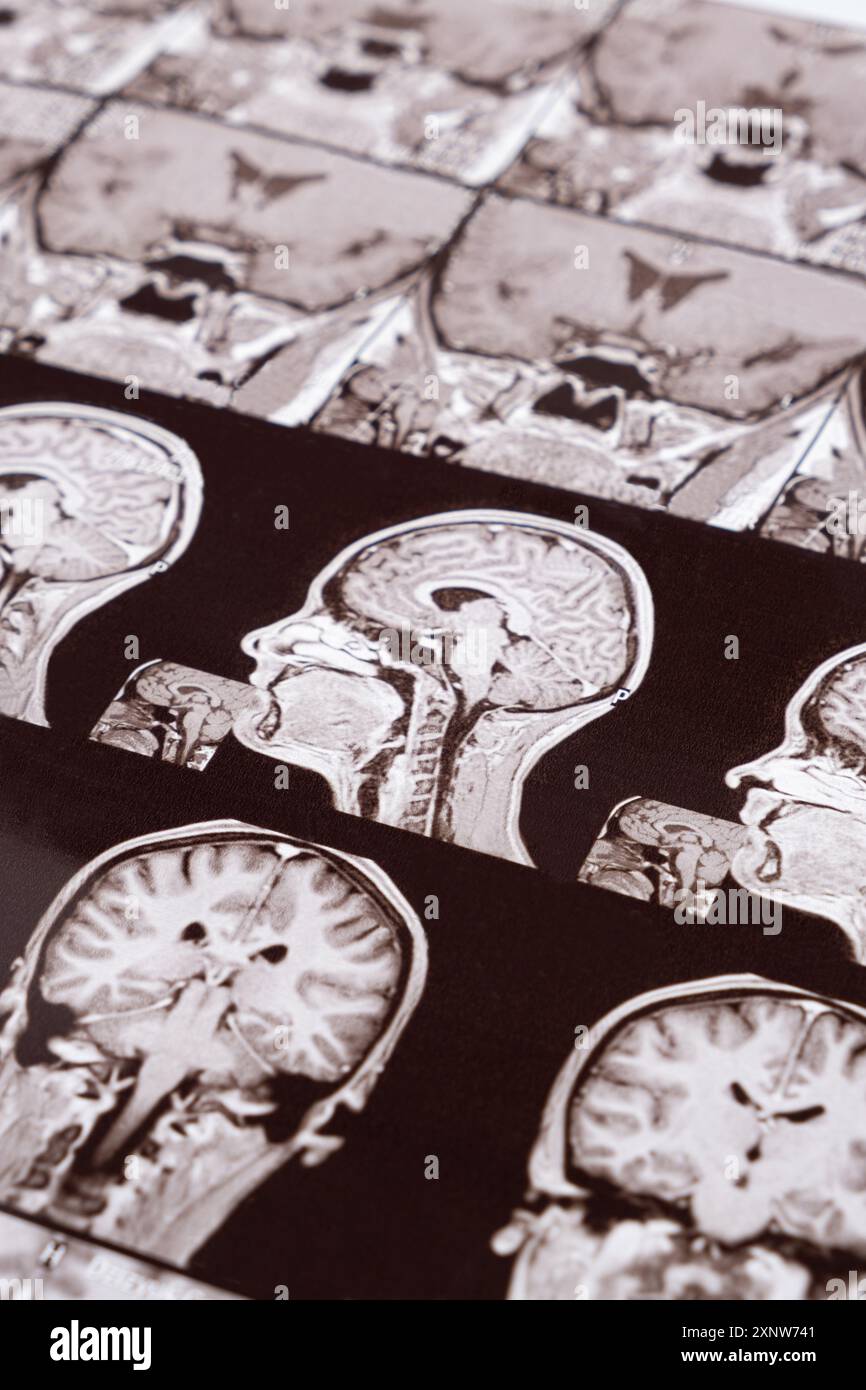 Imagerie par résonance magnétique de la tête d'une personne saine, image de l'hypophyse. Banque D'Images