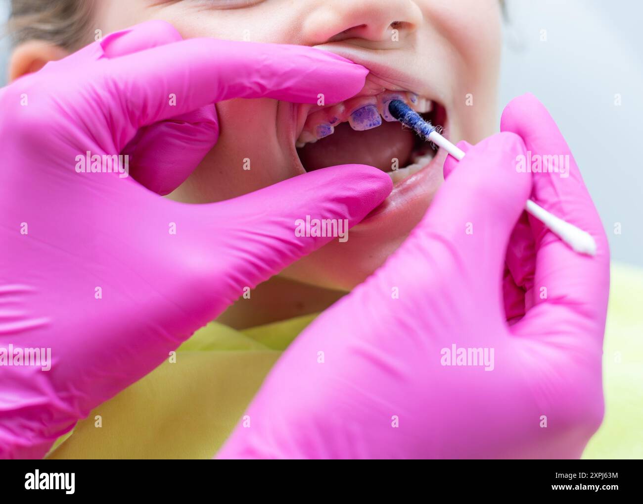 Dentiste appliquant une solution révélatrice de plaque dentaire sur les dents de l'enfant Banque D'Images