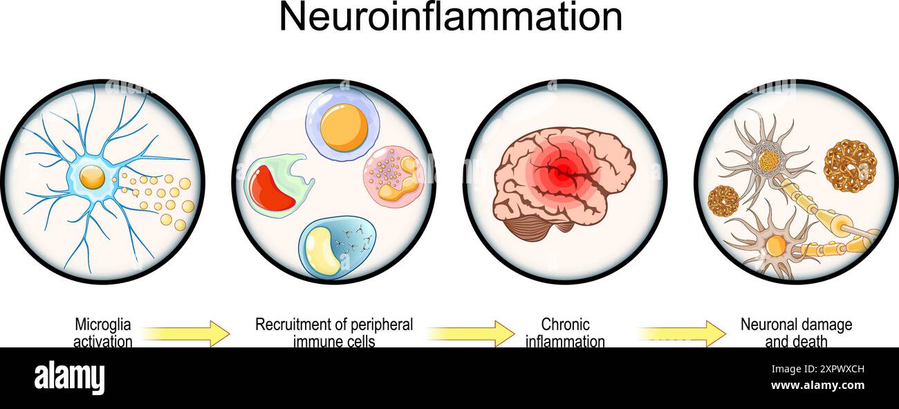 Neuroinflammation. Développement de maladies neurodégénératives de l'activation de la microglie et le recrutement des cellules immunitaires périphériques au cerveau chronique INF Illustration de Vecteur
