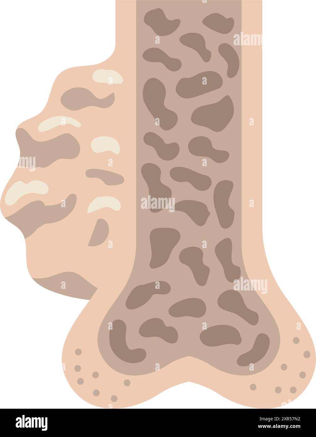 myélome multiple section transversale des os Illustration de Vecteur