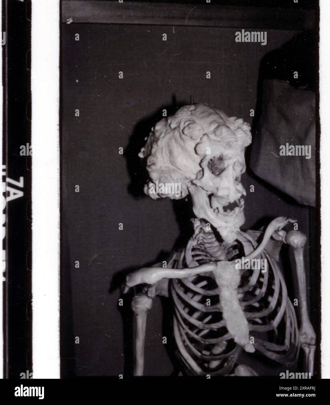 Joseph 'John' Carey Merrick (1862-90) - alias The Elephant Man. Collection de pathologie du Royal London Hospital de Whitechapel vers les années 1980 Banque D'Images