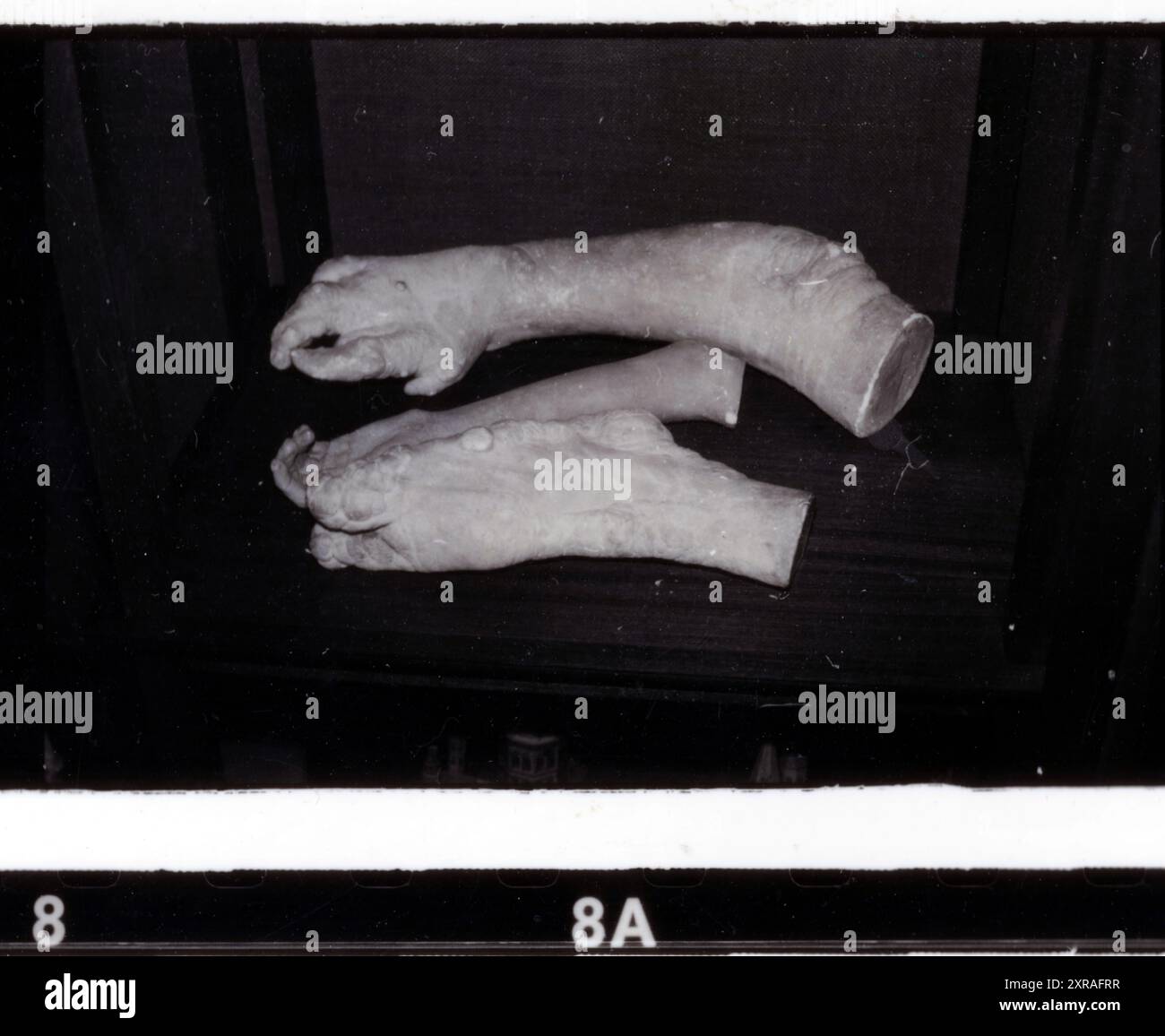 Joseph 'John' Carey Merrick (1862-90) - alias The Elephant Man. Collection de pathologie du Royal London Hospital de Whitechapel vers les années 1980 Banque D'Images