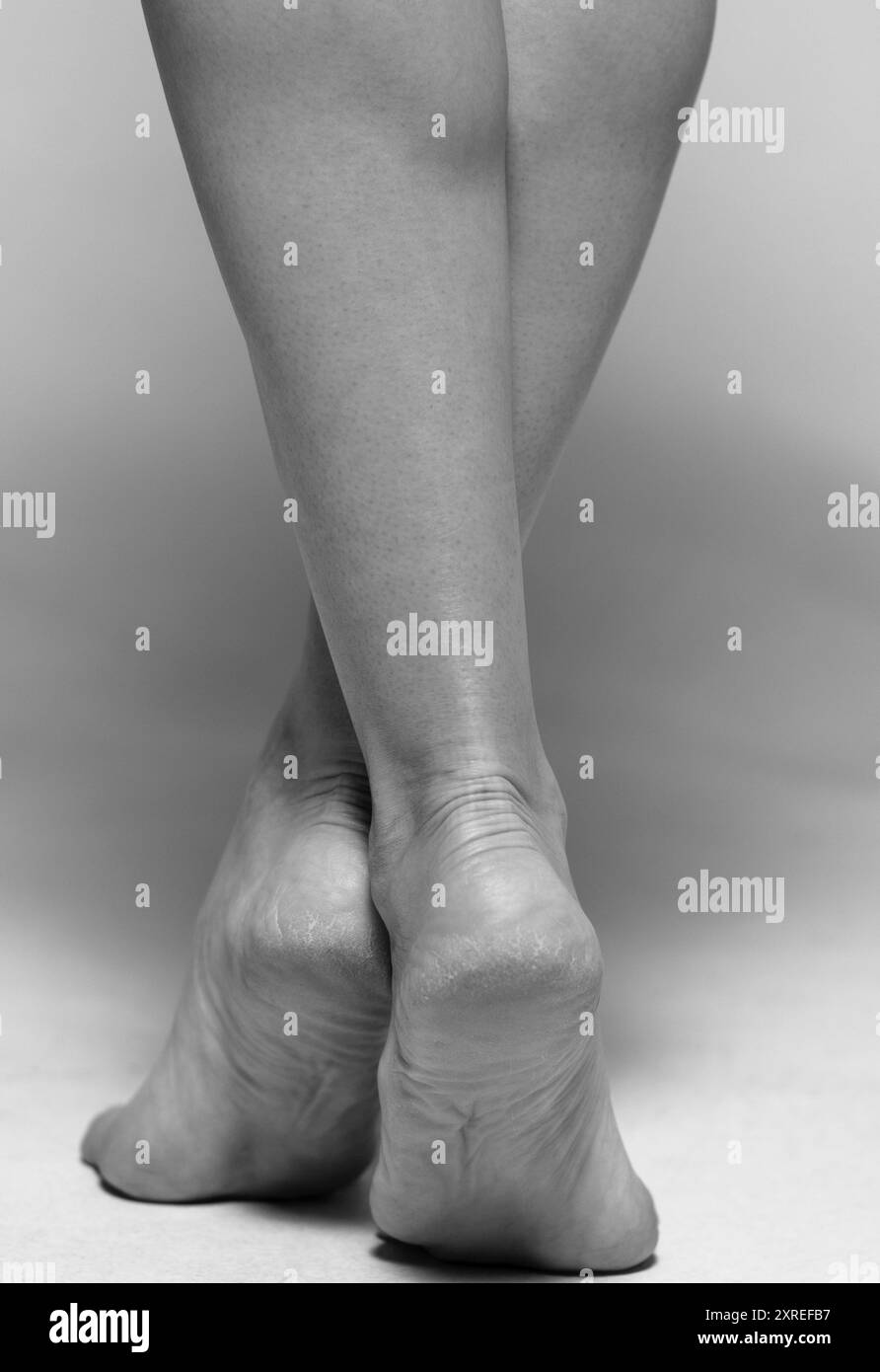 Peau sèche et craquelée sur les talons. Problèmes talons, gros plan. Banque D'Images