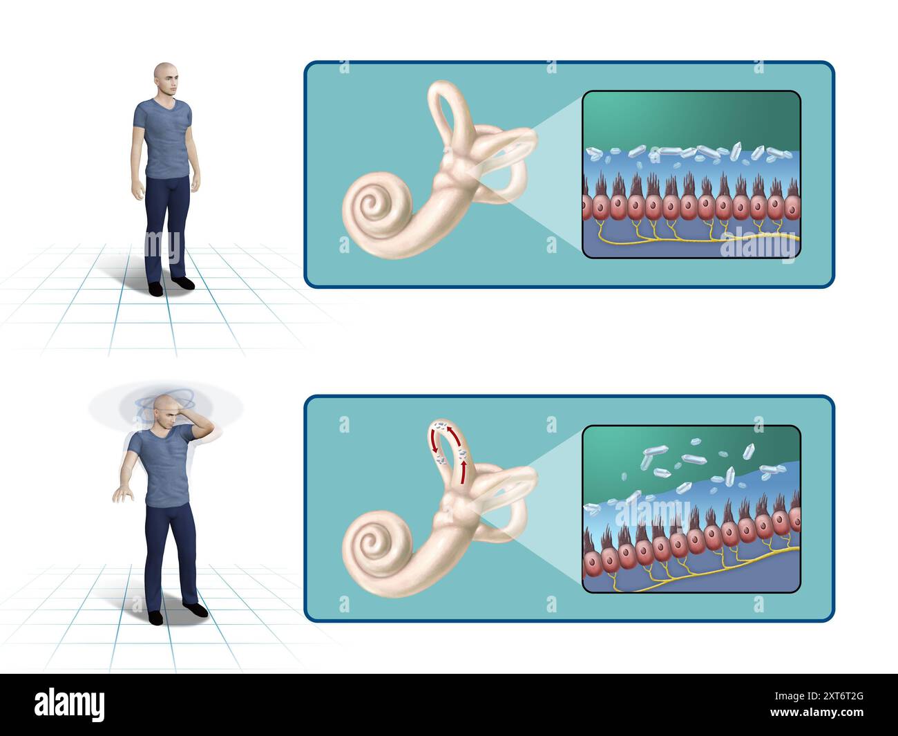 Vertige positionnel paroxystique Bénin. Vertiges par problèmes de l'oreille interne. Illustration numérique, rendu 3D. Banque D'Images