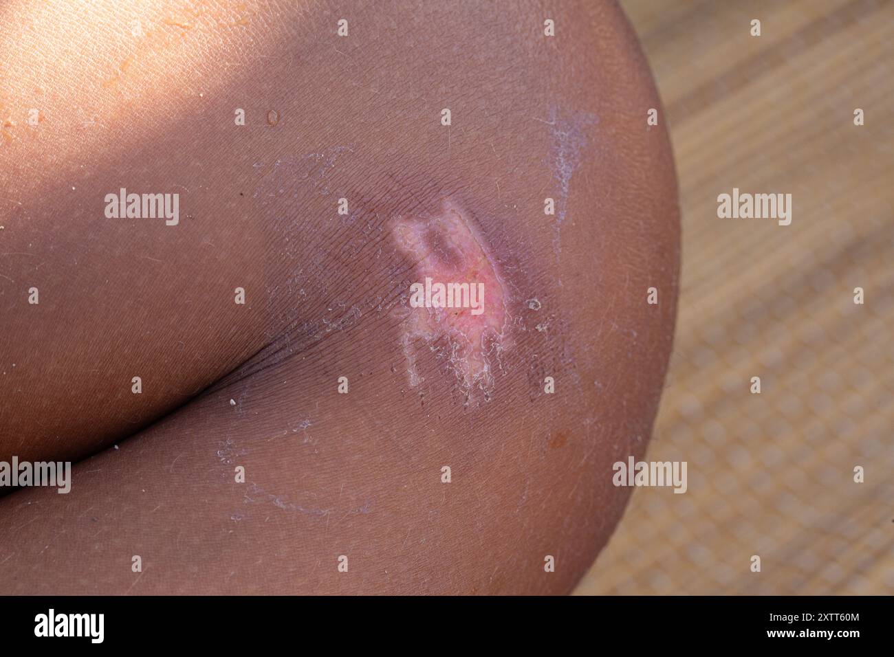 Cicatrisation de grandes brûlures sur peau foncée montrant la formation de chéloïdes Banque D'Images