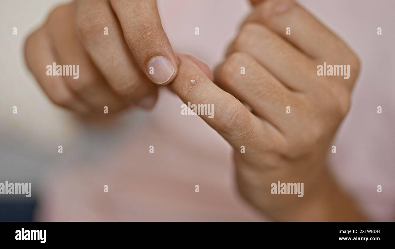 Gros plan d'une petite plaie sur le doigt d'un homme examiné attentivement par une autre personne, en mettant l'accent sur la blessure. Banque D'Images