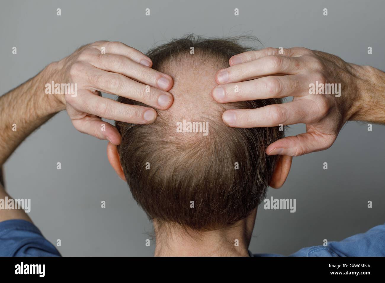 Personne perdante de cheveux. Gros plan sur la tête d'un homme chauve-souris Banque D'Images