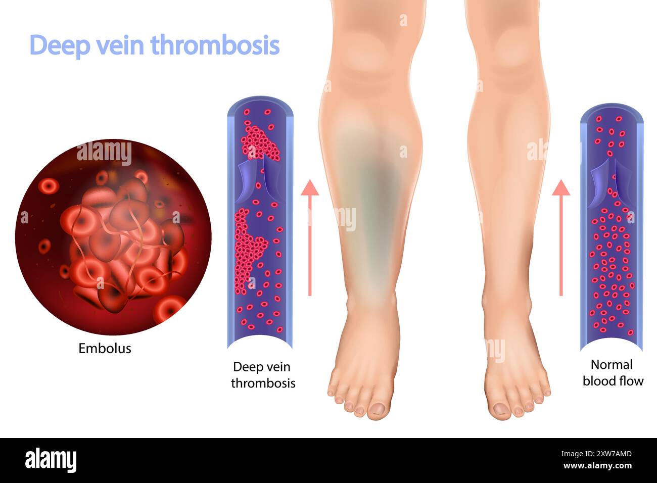 Thrombose veineuse profonde et débit sanguin normal. Flot sanguin anormal. Illustration de Vecteur