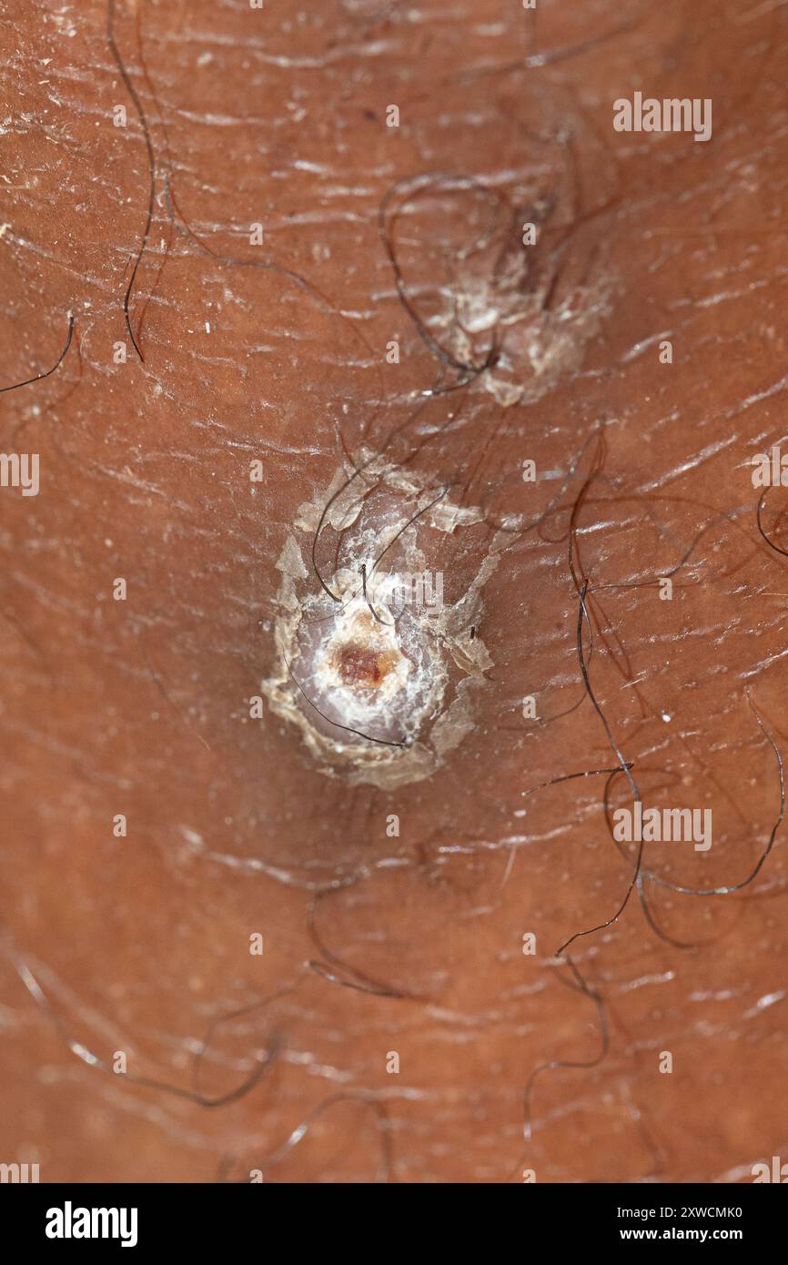 Photographie macro montrant le virus du molluscum contagiosum sur la peau humaine Banque D'Images