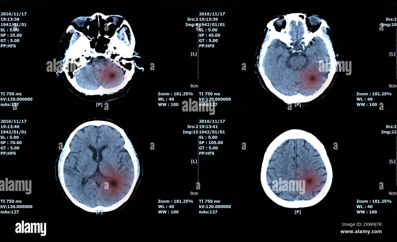 Scanner IRM du cerveau, scanner de l'image du cerveau pour le diagnostic hémorragie, tumeur. Banque D'Images