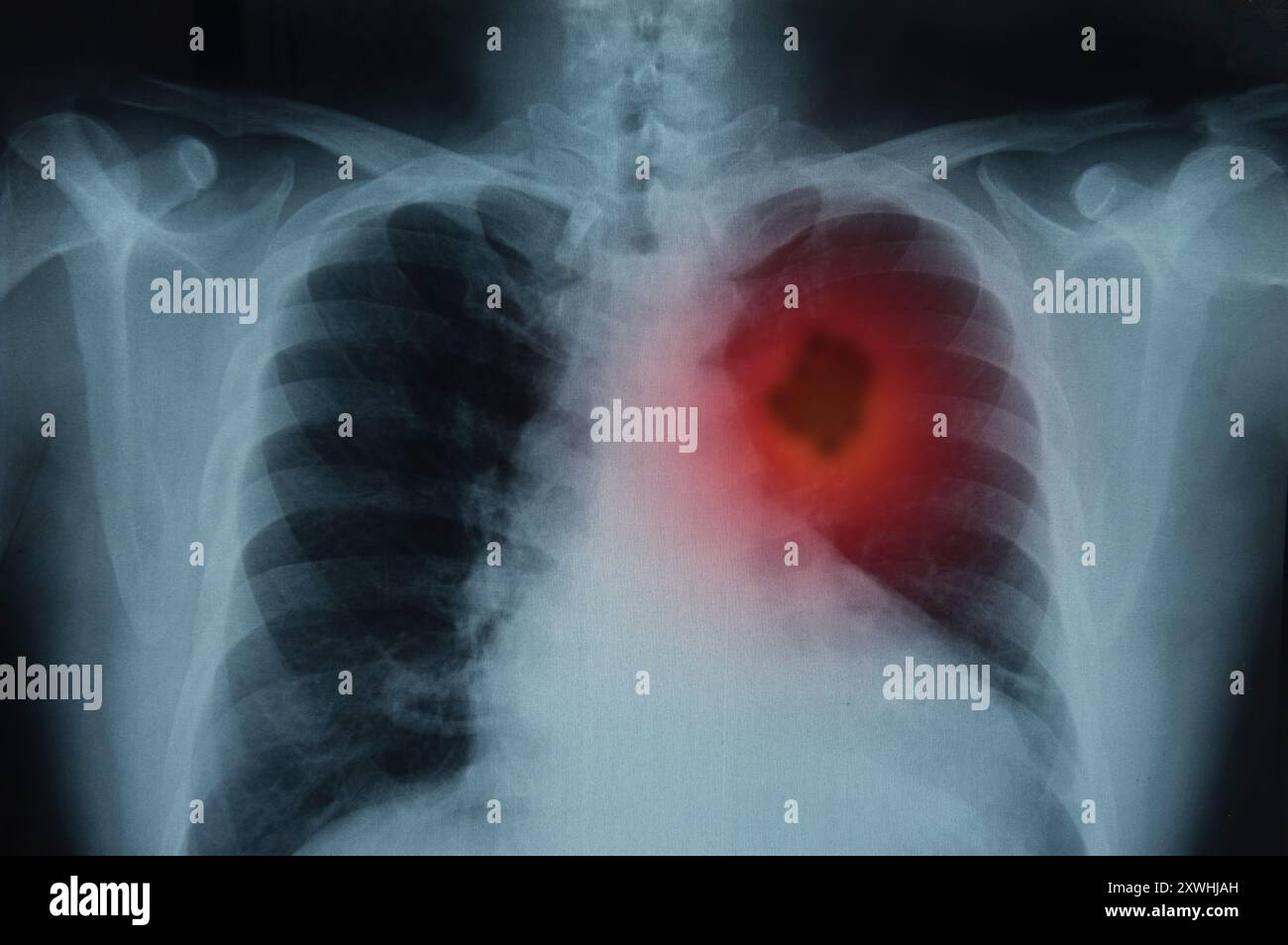 Cancer du poumon. Radiographie des poumons du patient à la tumeur pulmonaire. Banque D'Images