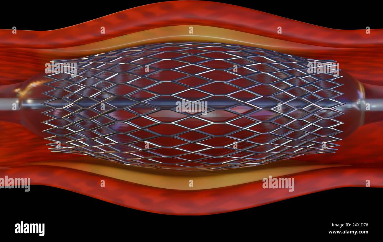 Un rendu 3D d'un stent à l'intérieur d'un capillaire sanguin permet de visualiser la procédure. L'angioplastie est une procédure pour ouvrir des vaisseaux sanguins rétrécis ou bloqués. Banque D'Images
