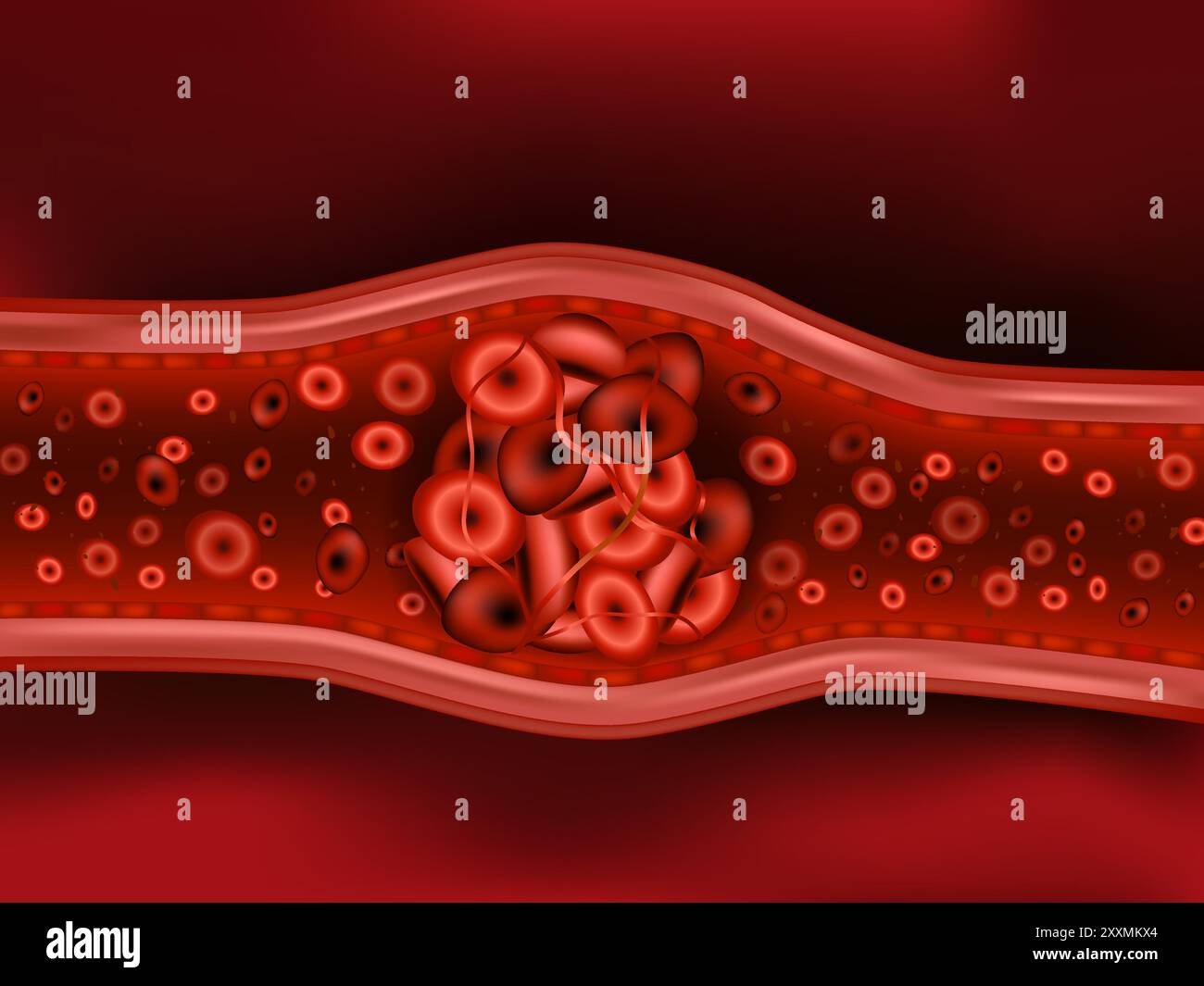 Illustration représentant une embolie par détachement d'un thrombus. Caillots sanguins ou thrombus avec érythrocytes coagulés. Embole. Illustration de Vecteur