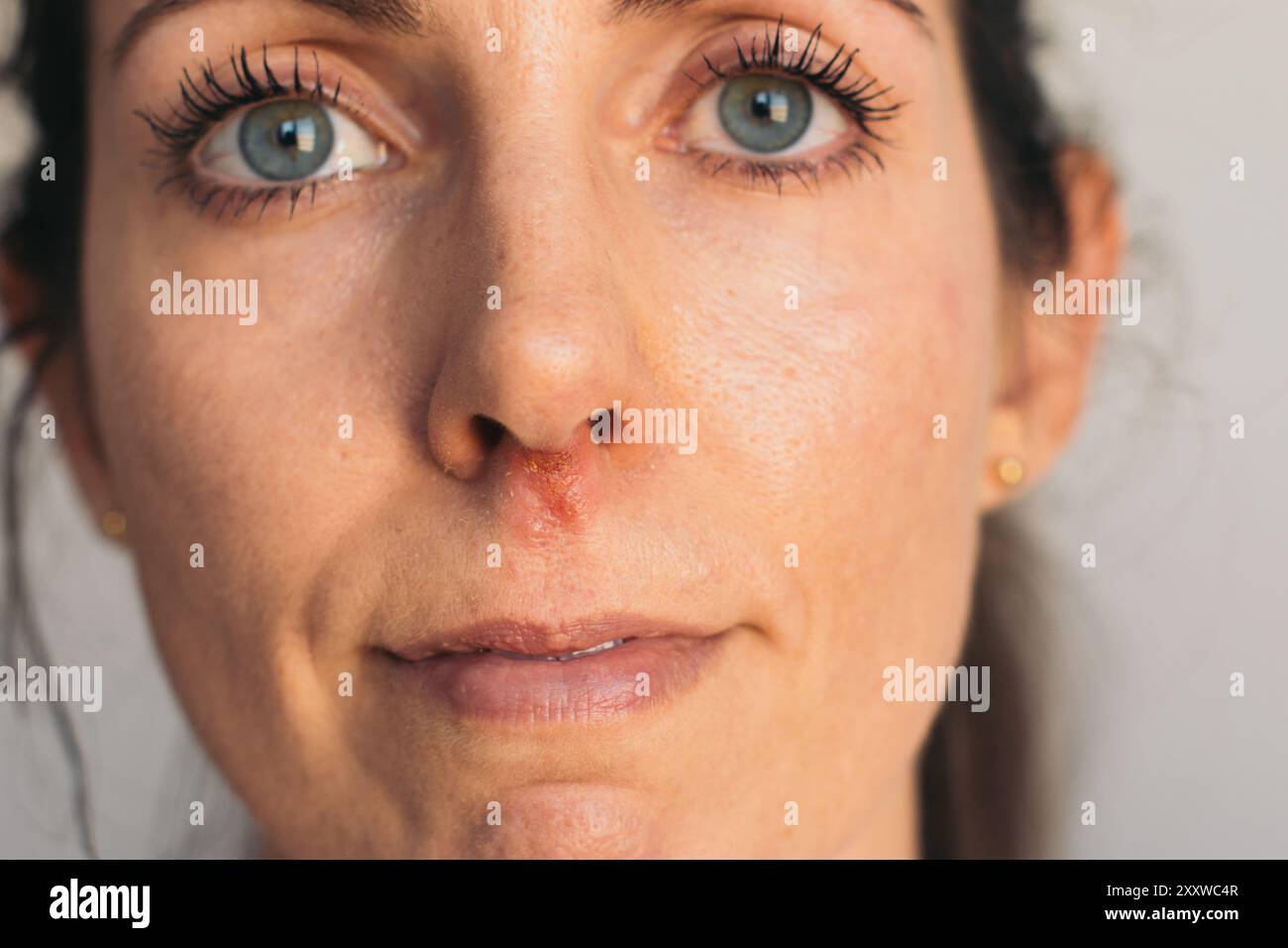 Portrait de femme avec l'herpès douloureux sous le nez Banque D'Images Portrait de femme avec l'herpès douloureux sous le nez Banque D'Images