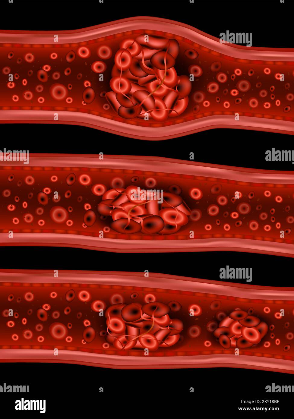 Illustration des types de thrombus. Types de caillots sanguins. Illustration de Vecteur