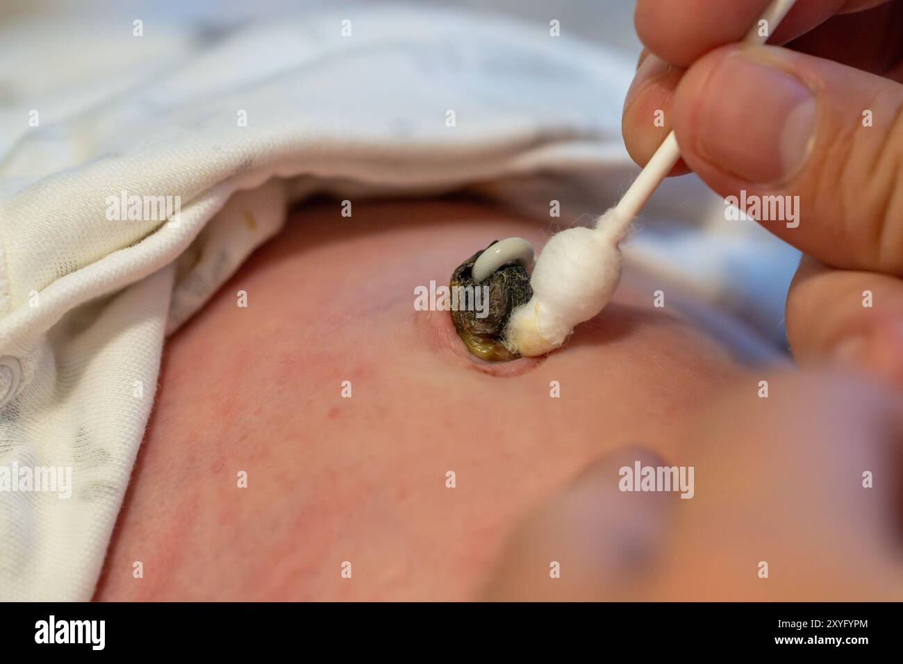 Un moignon de cordon ombilical pour nourrissons est soigneusement nettoyé avec un coton-tige Banque D'Images