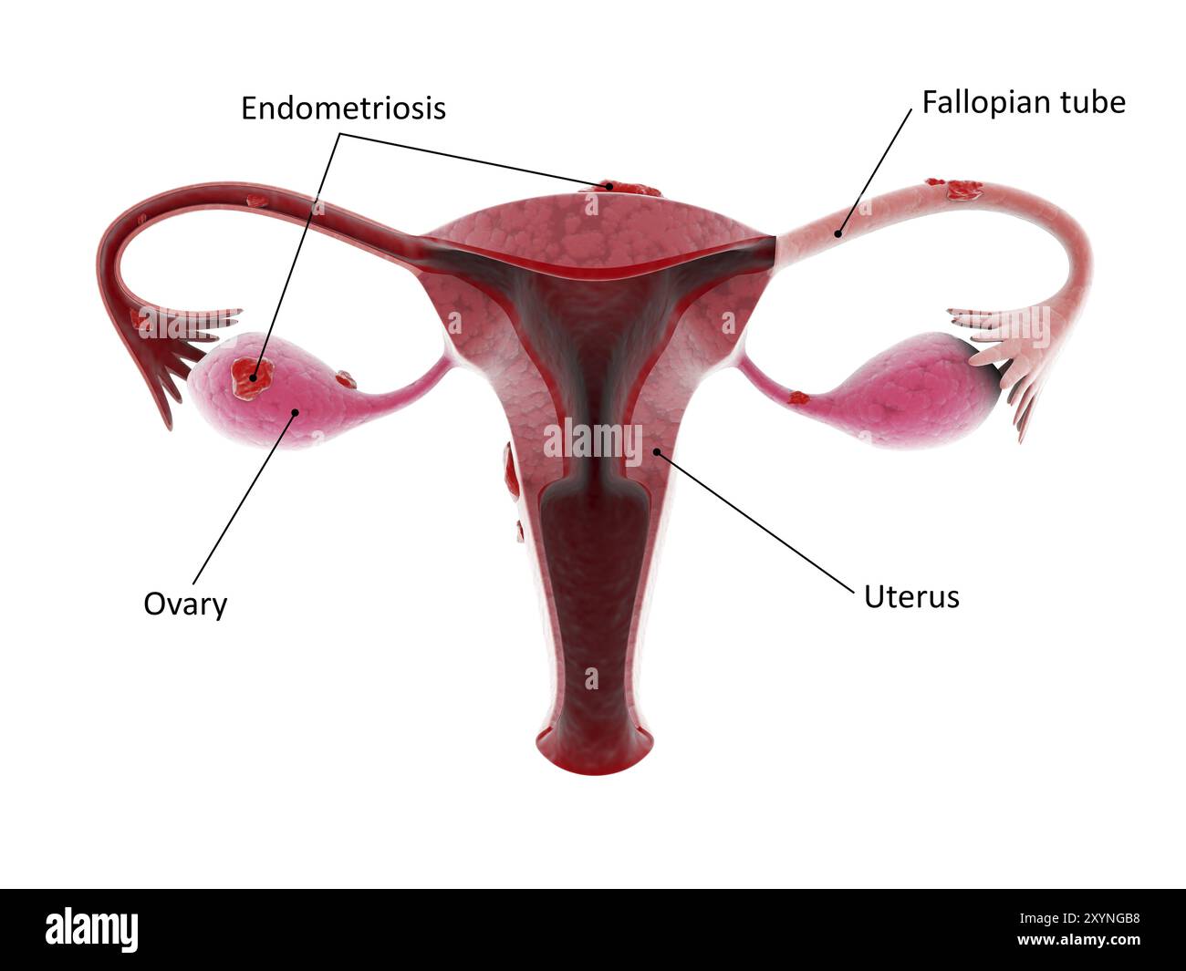 Illustration médicale d'un organe reproducteur féminin malsain avec endométriose Banque D'Images