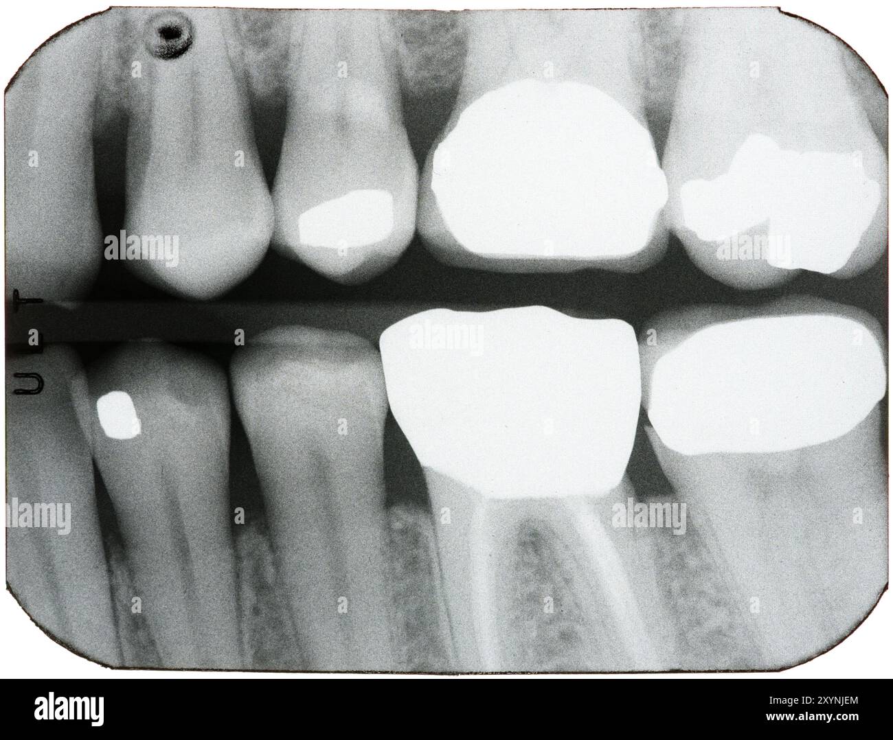 Radiographies dentaires des dents à l'arrière de la bouche, montrant brillamment les couronnes, les canaux radiculaires et les obturations où des caries et des caries avaient été trouvées. Banque D'Images
