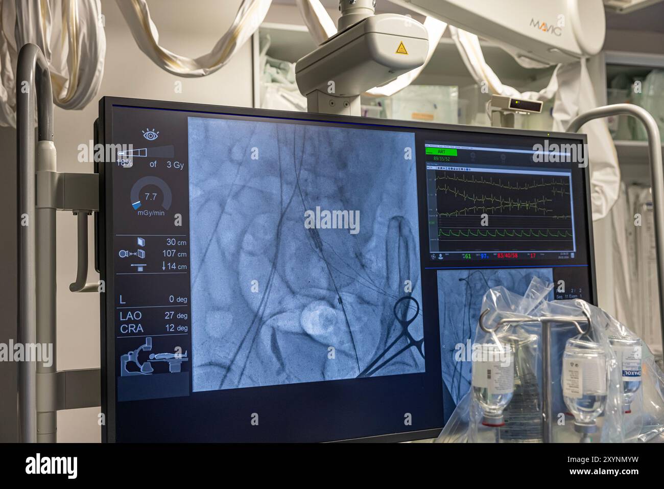 Istanbul, Turquie 29 février 2024 ; radiographie pour remplacement valvulaire avec valve mélodique. Vue d'une dysfonction valvulaire prothétique chez un patient atteint de mi Banque D'Images