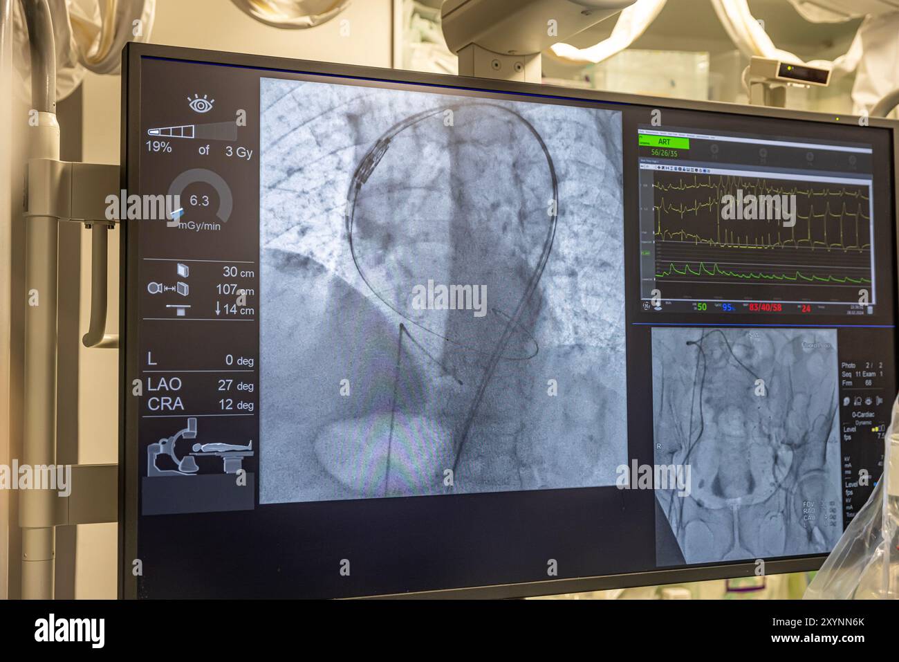 Istanbul, Turquie 29 février 2024 ; radiographie pour remplacement valvulaire avec valve mélodique. Vue d'une dysfonction valvulaire prothétique chez un patient atteint de mi Banque D'Images